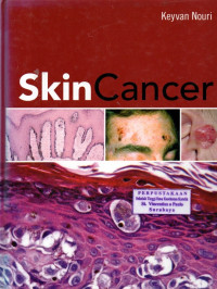 Image of Skin Cancer